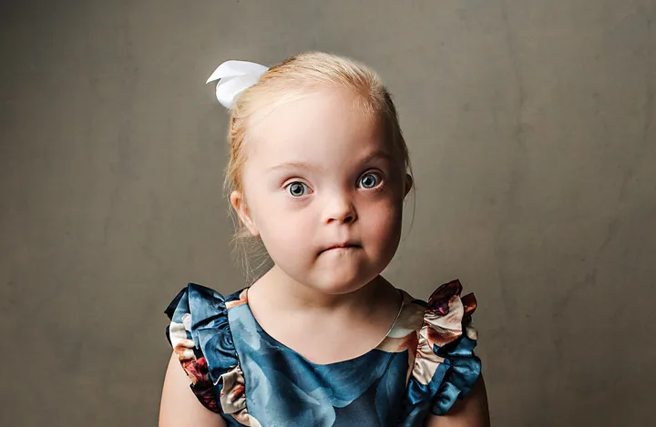 Picture of a little girl with downs syndrome.