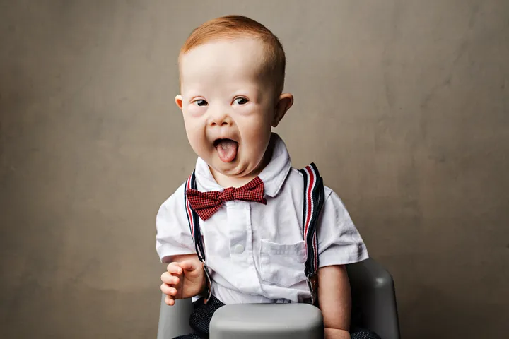 Picture of a toddler with downs syndrome.