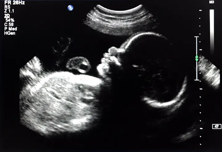 Picture of an ultrasound of Aaron Broverman's son.